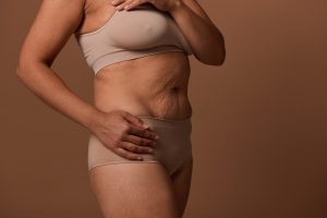Abdominoplastia: o que muda antes e depois da cicatriz