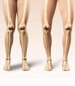 Seus joelhos estão alinhados Veja o que o formato das suas pernas pode revelar