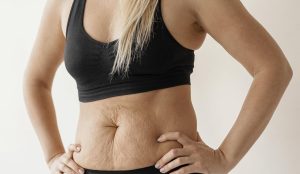 Diástase Abdominal em Goiânia: Quando Considerar a Abdominoplastia?