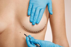Dr. Reyner Abrantes Stival: Escolhendo o Implante Mamário Certo para Você