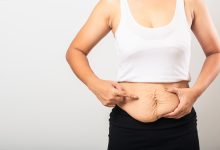 Abdominoplastia em âncora a cirurgia que transforma corpos e autoestima, com o olhar especializado do Dr. Reyner Abrantes Stival