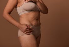 Abdominoplastia: o que muda antes e depois da cicatriz
