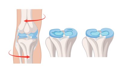 Dor, estalos e travamento no joelho Pode ser lesão no menisco