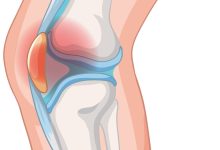 Dor na frente do joelho Pode ser condropatia patelar