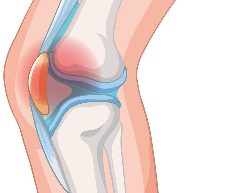 Dor na frente do joelho Pode ser condropatia patelar