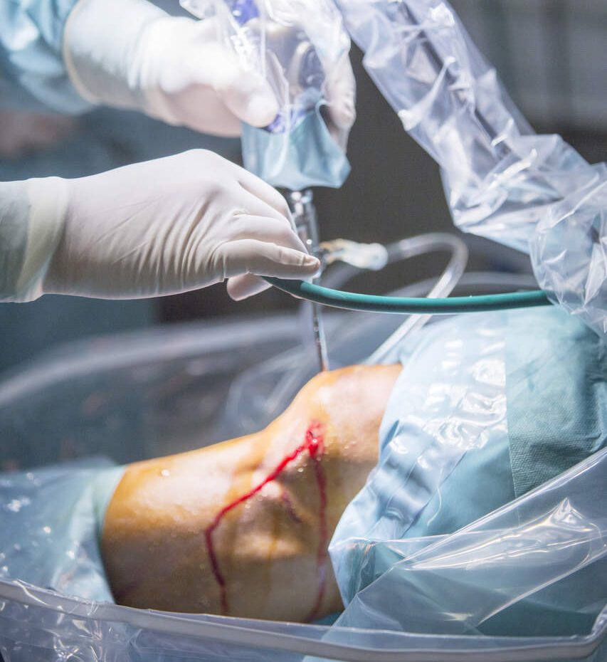 Sutura do menisco quando ela é indicada